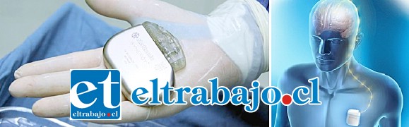 SÍ ES POSIBLE.- Esta imagen muestra cómo va instalado el neuroestimulador en el cuerpo de Nicolás, si todos le ayudamos a lograrlo.