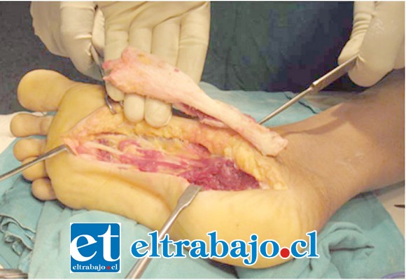 OPERADA DOS VECES.- La fibromatosis plantar que sufre doña Griselda, también llamada enfermedad de Ledderhose o fibromatosis de la aponeurosis plantar, en una enfermedad de carácter benigno que se caracteriza por la aparición de tejido fibroso proliferativo en la aponeurosis de la planta del pie. (Referencial)