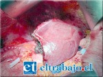 La hepatitis A que sufre la pequeña P.R.C., de trece años, es una enfermedad infecciosa causada por el virus de la hepatitis A (VHA), caracterizada por una inflamación aguda del hígado en la mayoría de los casos.