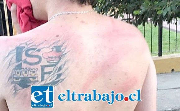 Francisco Ibaceta, operado recientemente de la espalda, recibió 10 golpes de luma que quedaron claramente marcados en su cuerpo, denunciando como una brutalidad el actuar de Carabineros.