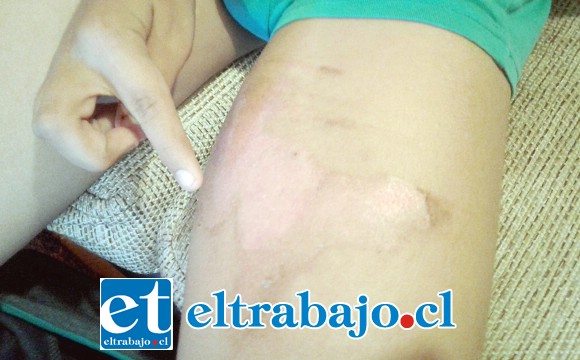 Actualmente la herida en su pierna izquierda ha logrado sanar, aunque prevalece una mancha roja, ignorando si quedaran marcas de esta dolorosa experiencia.