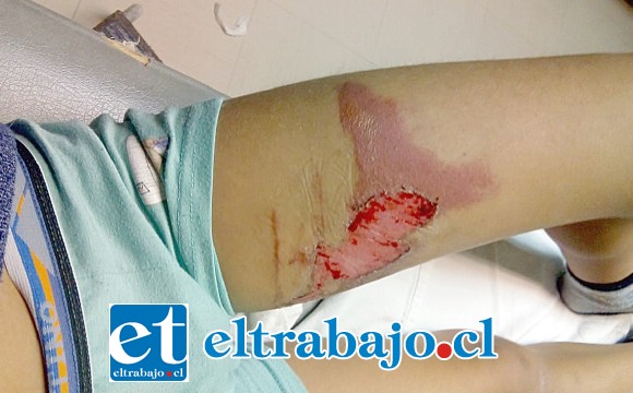 En la imagen se puede apreciar la magnitud de la quemadura el día que ocurrió el incidente.