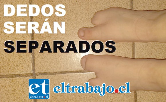 NECESITA OPERACIÓN.- Así lucen ambos pies de esta estudiante de tercero medio, quien ya tiene millón y medio de pesos ahorrados parta su operación.