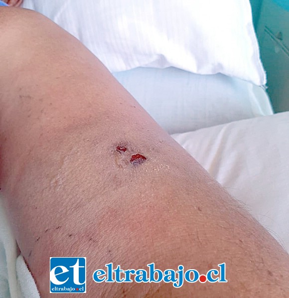 Los primeros días después de la mordedura de araña de rincón, don Rubén lucía pequeñas marcas en su brazo.