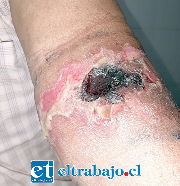 Actualmente el paciente de 59 años de edad se encuentra levemente mejor, aunque la lesión en su brazo ha ido evolucionando.