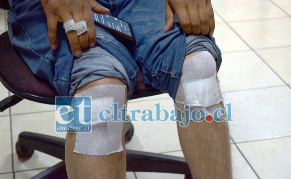 RODILLAS TAMBIÉN.- Las rodillas del vecino, según el mismo denunciante, también están muy golpeadas.